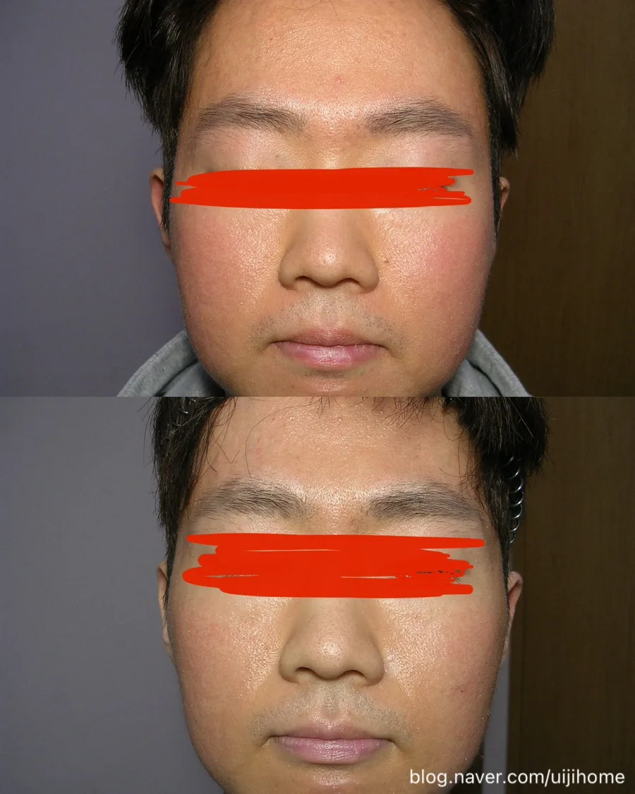 지루성 피부염 한의원 치료 9개월 후기: 증상 변화와 솔직한 경험 2026 3