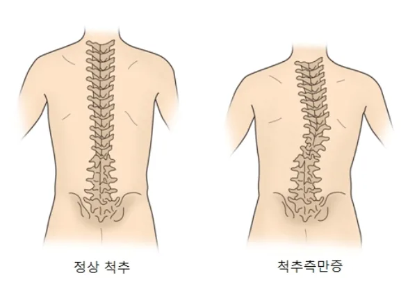 척추측만 수술 후 필라테스 회복 여정 2026: JW님의 Before & After 3