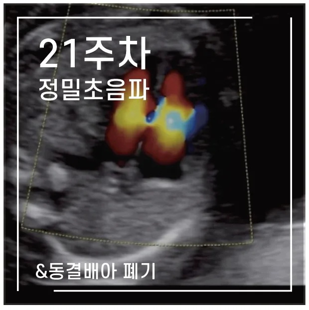 임신 21주차 정밀초음파 후기: 태아 건강과 동결배아 결정 2026 — 육아·결혼 — 1991kate