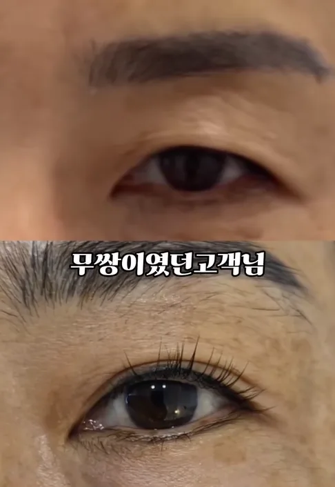 눈꺼풀 리프팅, 레이저 없이 자연스러운 효과 2026년 최신 정보 — 건강·의학 — ekqhr4857