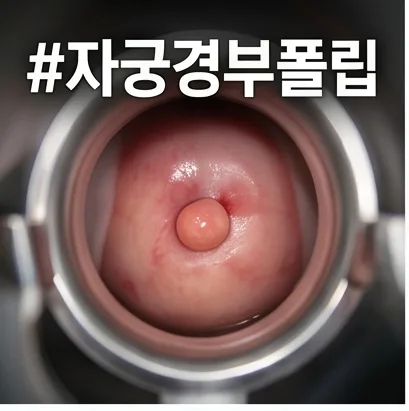 성관계 후 출혈, 자궁경부 폴립 제거 방법과 주의사항 2026 3