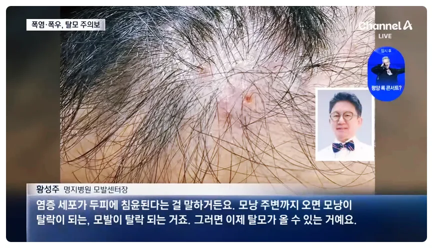 2026년 여름철 탈모 예방: 장마·폭염 두피 관리법 총정리 3