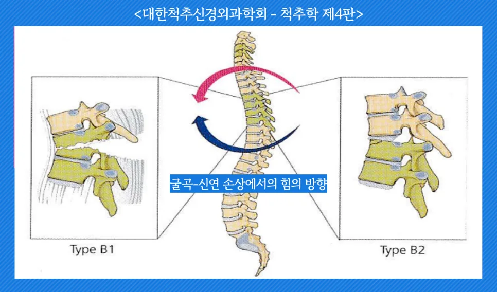 척추 압박골절 후유장해 보상 2026: 개인/산재/근재보험 완벽 정리 3