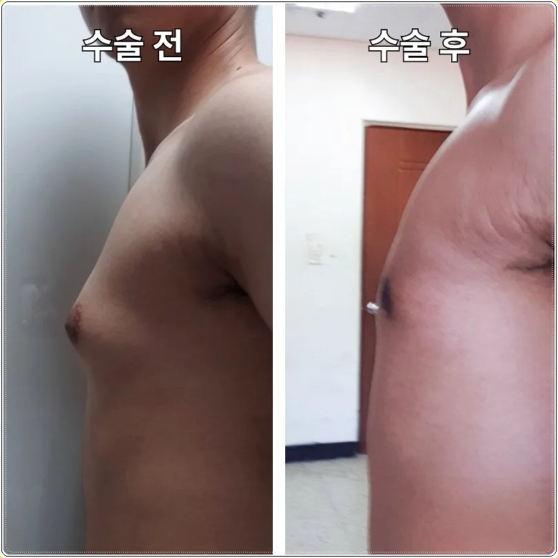 여성형유방증 수술, 2026년 진단부터 회복까지 총정리