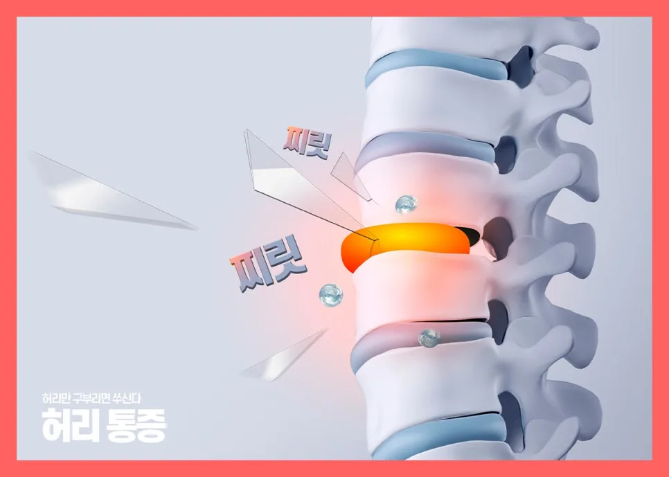 허리디스크 보험, 실비 외 추가 보장 2026년 총정리
