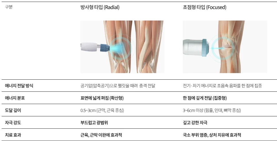 체외충격파 원리 및 적응증 2026: 만성 통증 해결법 3가지 3