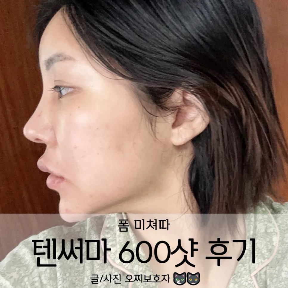 강남구청역 텐써마 600샷 통증 적은 후기 2026 — 건강·의학 — ozzizzizzi