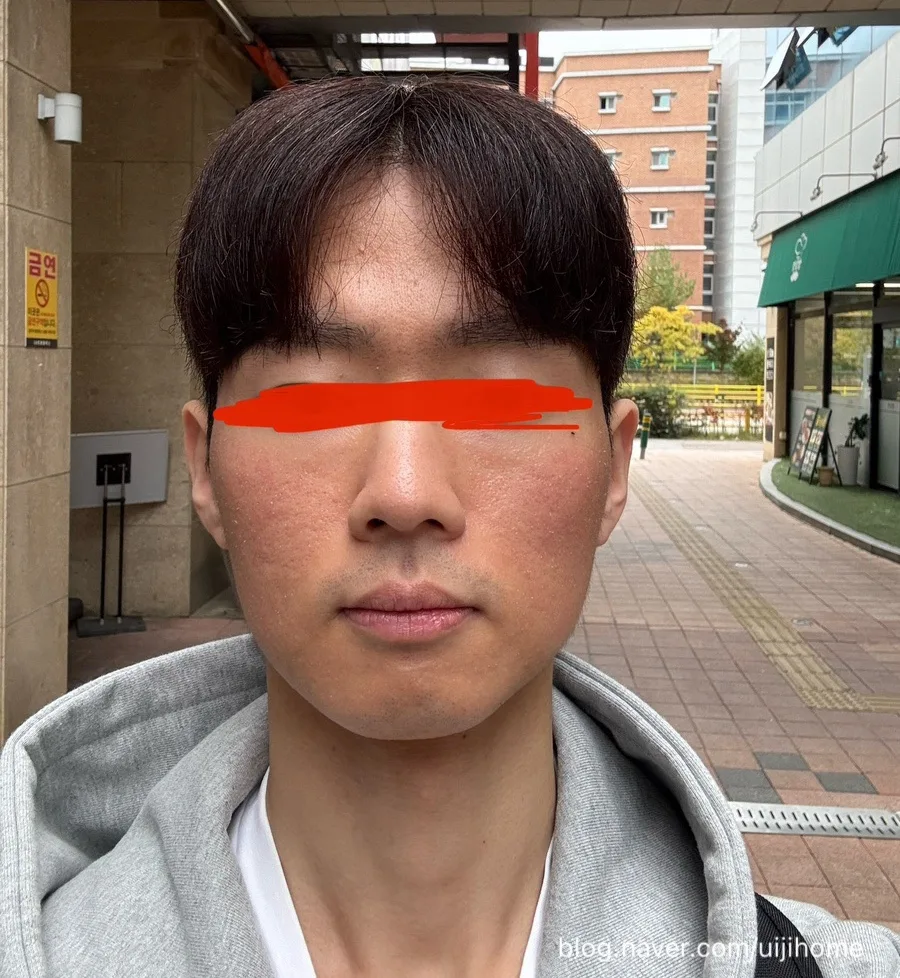 청주 S의원 피코슈어토닝 2회차 후기 (2026년 최신 정보) — 건강·의학 — uijihome