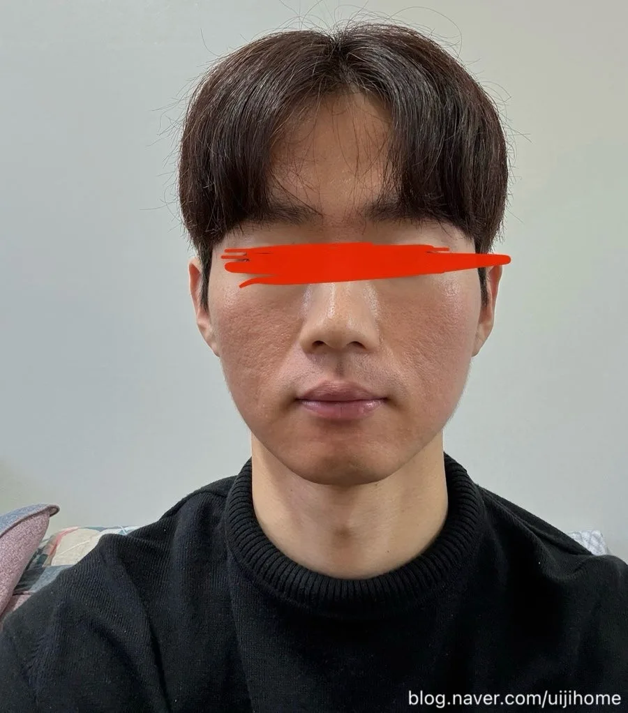 청주 S의원 피코슈어토닝 2회차 후기 (2026년 최신 정보) 3