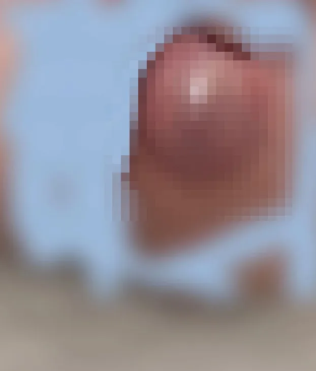항문직장농양 수술비 보험 청구 방법 2026: 실비·수술비 특약 완벽 정리 2