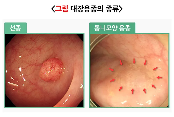 무경성 톱니형 병변이란? 대장내시경 조직검사 결과 2026년 총정리 3