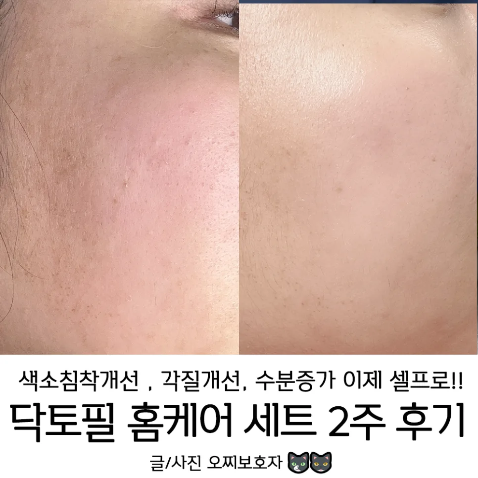닥토필 홈케어 2026: 물광 피부 만드는 유산균 필링 후기 3