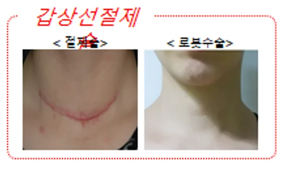 로봇수술 보험 적용 여부 2026년 총정리: 실비부터 수술비까지 2