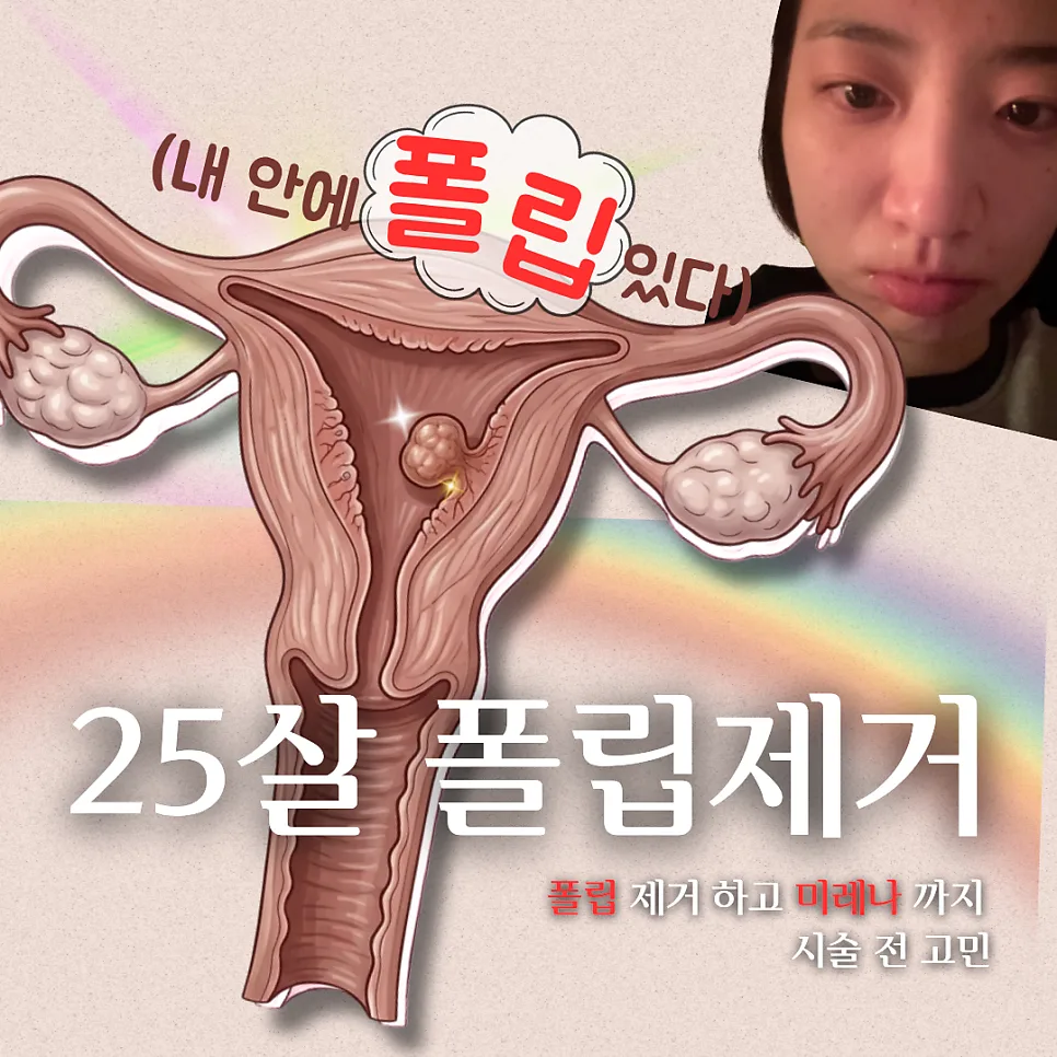 자궁 폴립 제거 및 미레나 시술 후기 (2026년 최신 정보) — 건강·의학 — josumin0330