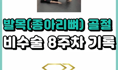 비골 골절 비수술 9주차: 깁스 해제 및 재활 운동 기록 2026 2