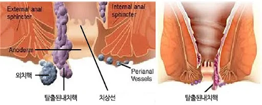 치질 수술 보험 보장 범위 2026년 총정리: 실비만으론 부족한 이유