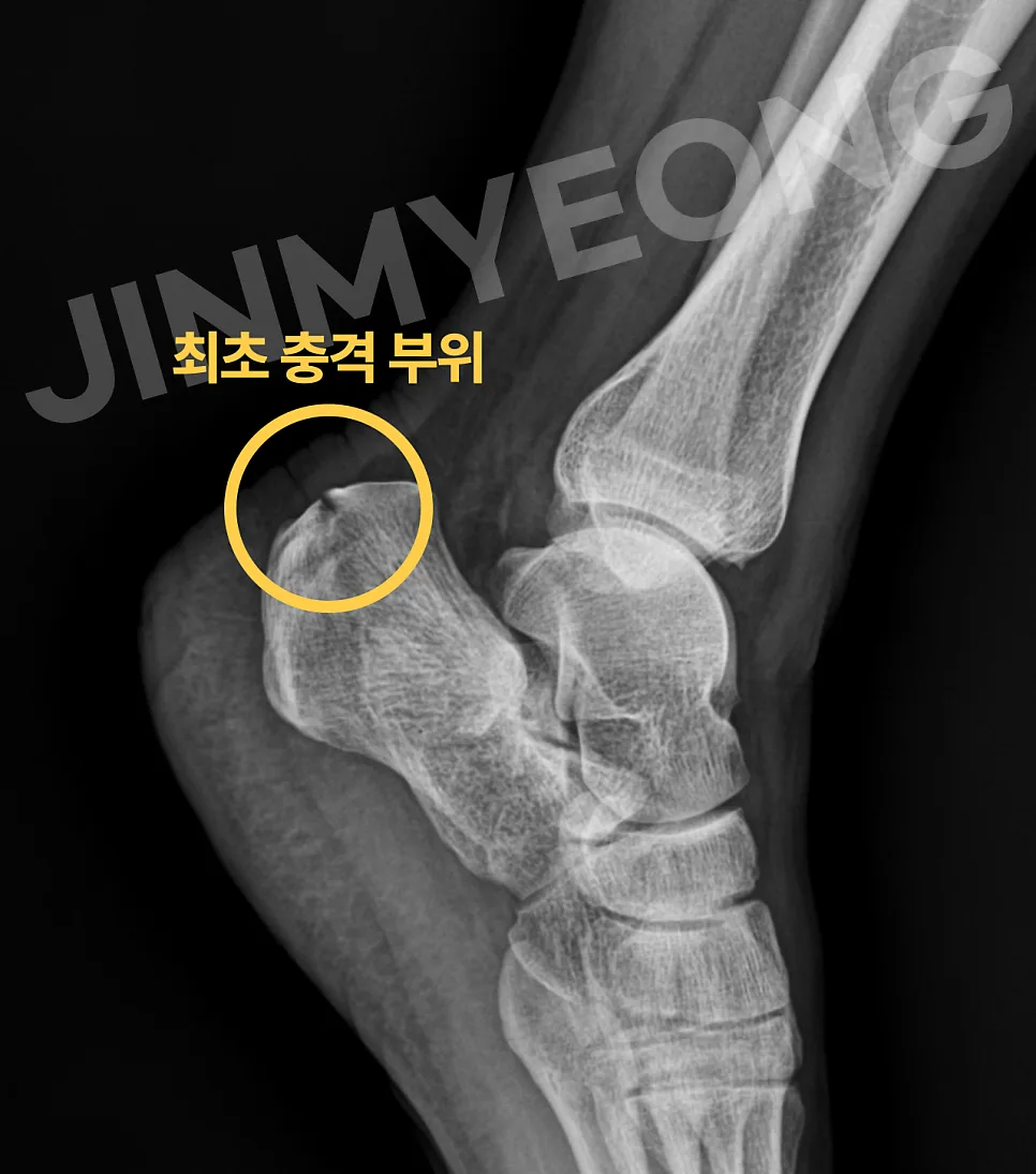 종골 분쇄골절 후유장해 보험금, 2026년 보상받는 핵심 전략 3