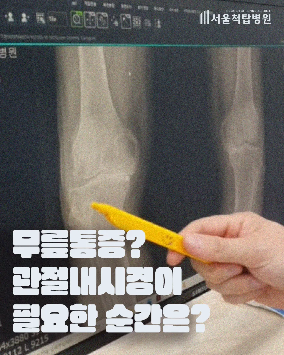 무릎 관절내시경 수술 2026: 통증 잡고 일상 복귀 빠른 방법 — 건강·의학 — topspinejoint