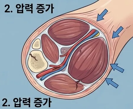 급성구획증후군 증상, 골든타임 놓치지 않는 법 2026 2