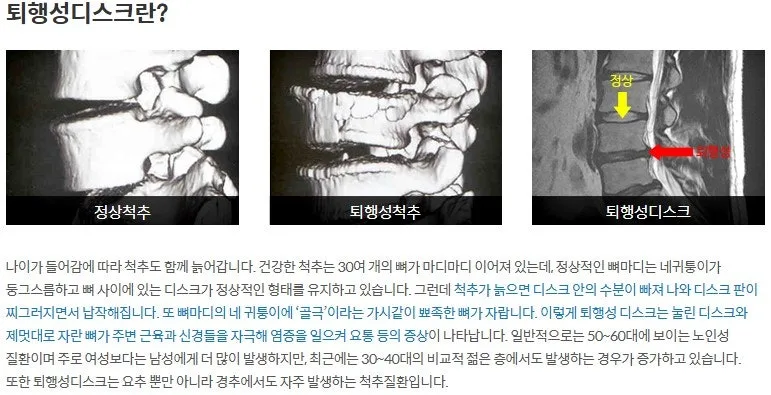 퇴행성 디스크 재활 필라테스, 통증 완화 효과 2026년 최신 분석 3