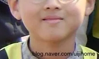 지루성 피부염 원인과 증상: 2026년 최신 정보 총정리