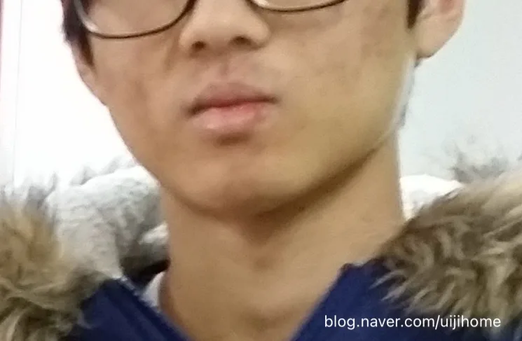 지루성 피부염 원인과 증상: 2026년 최신 정보 총정리 3