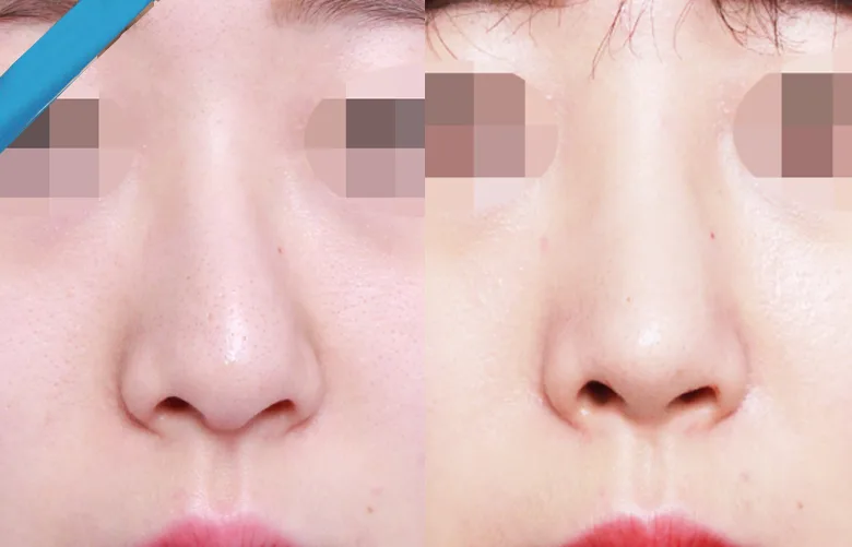 비중격만곡증 수술 비용과 보험 적용 2026년 총정리 — 건강·의학 — dami_yummy