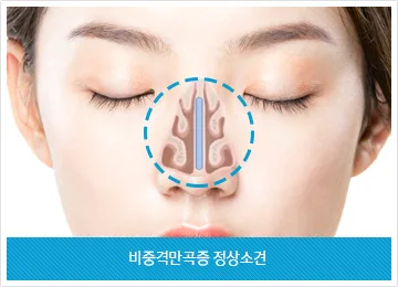 비중격만곡증 수술 비용과 보험 적용 2026년 총정리 2