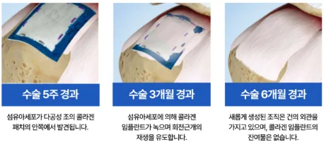 회전근개 파열 재파열 걱정 끝? 리제네텐 치료 2026년 총정리 2