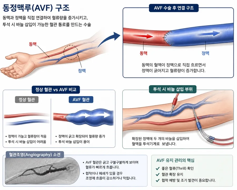 동정맥루 AVF 수술, 관리, 비용 완벽 정리 (2026년 최신 정보)