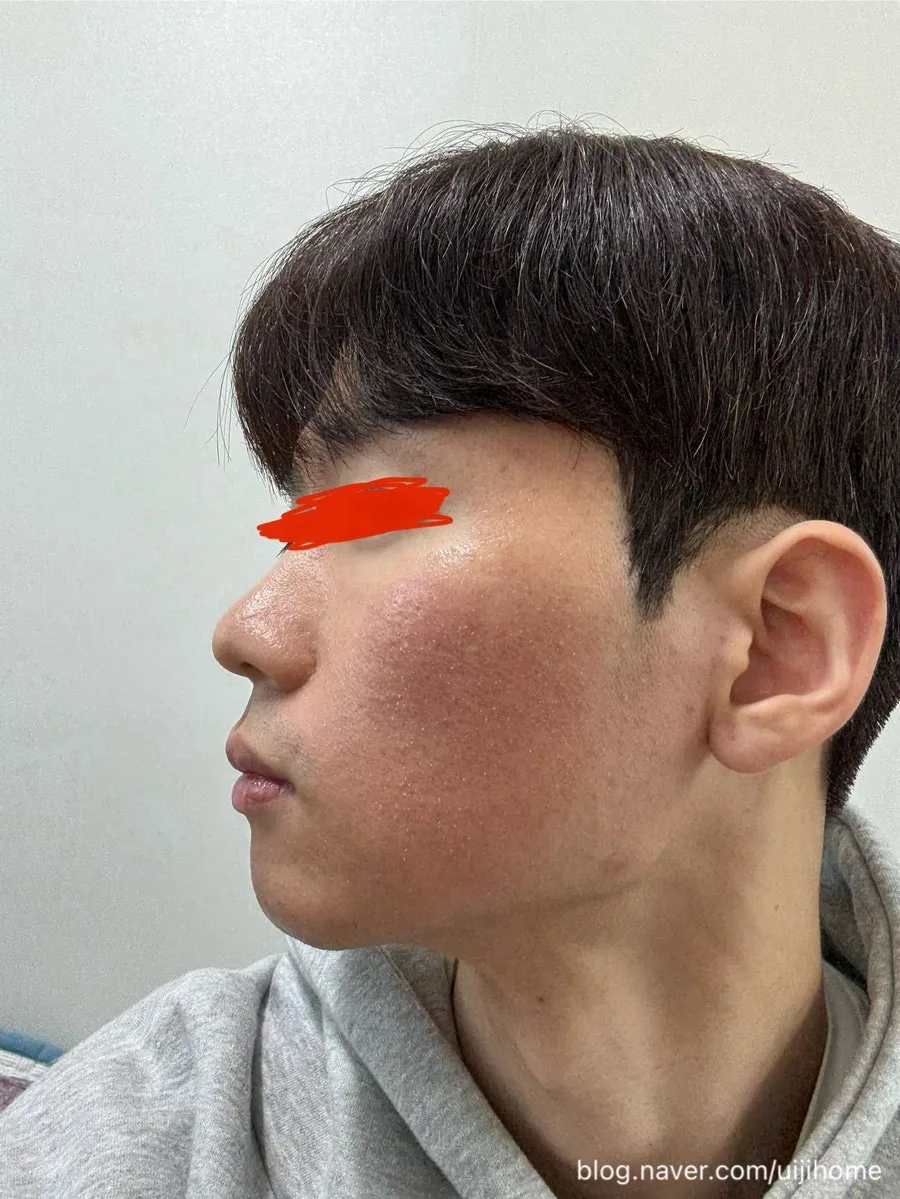 지루성 피부염 1회차 시술 후기: 피부과 레이저 효과 2026 3
