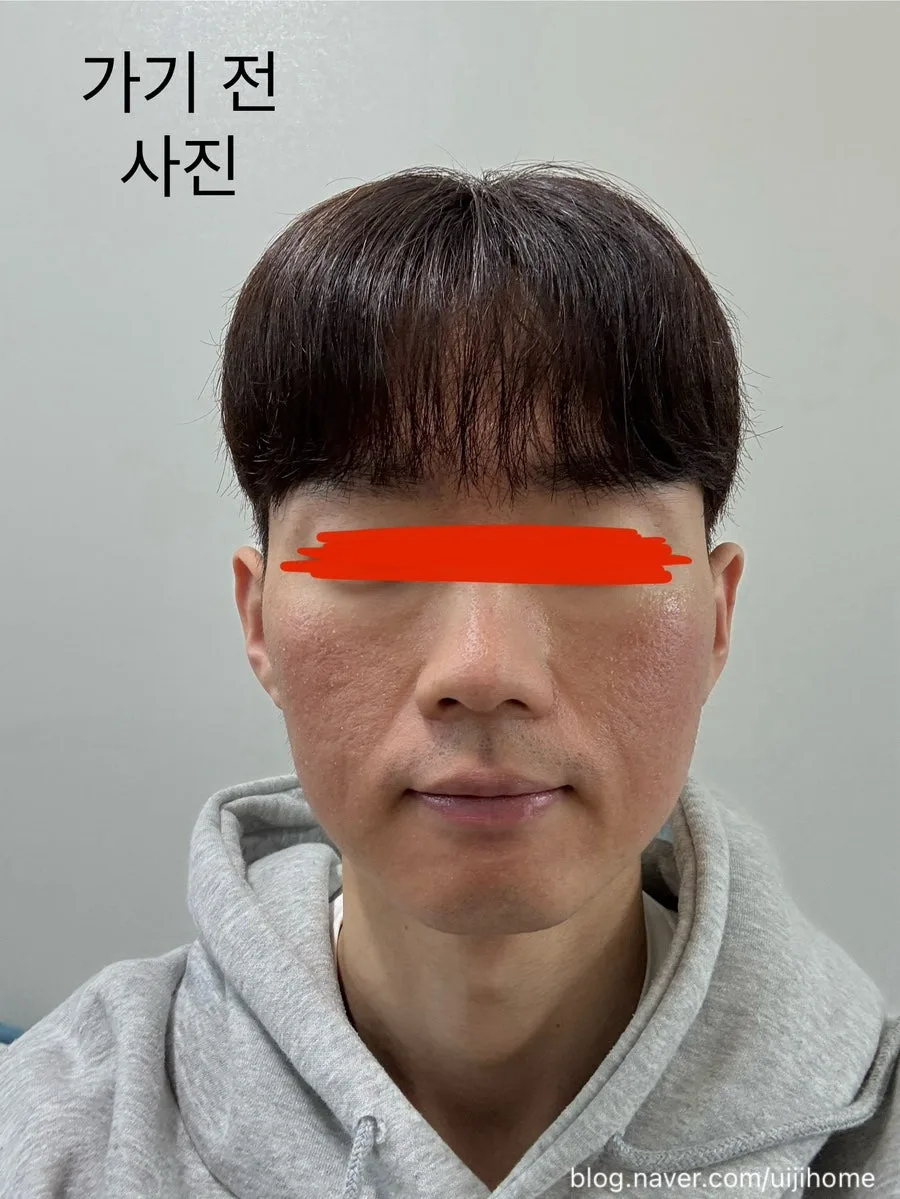 청주 S 의원 피부과 시술 후기 2026: 시크릿 레이저, NMN 침투 효과 3