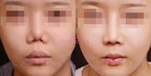 코 구축 증상과 원인: 딱딱해진 코, 들창코 변형 해결법 2026