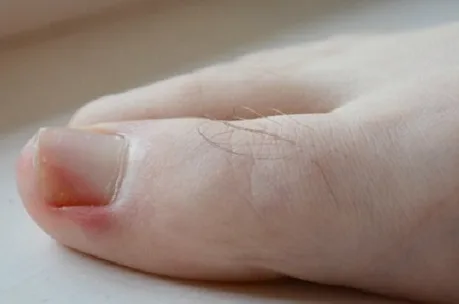 내성발톱 초기 자가치료 가능할까? 피부과 진료 기준 2026 3