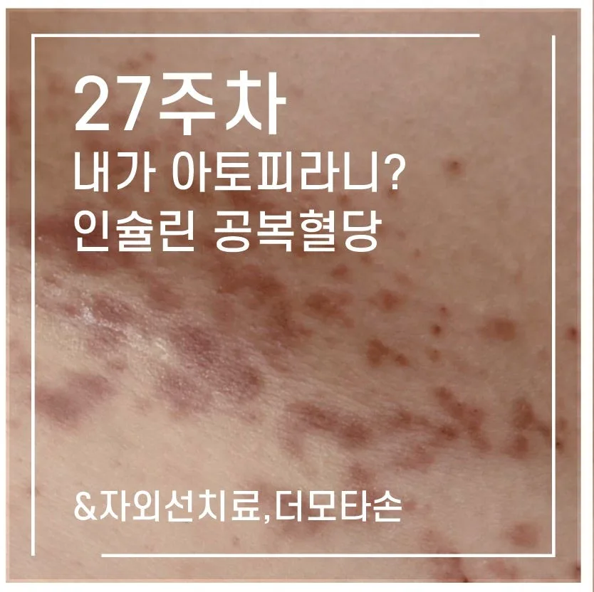 임신 27주차 피부 질환: 아토피, 한포진 치료법 및 임당 관리 2026 — 건강·의학 — 1991kate 1