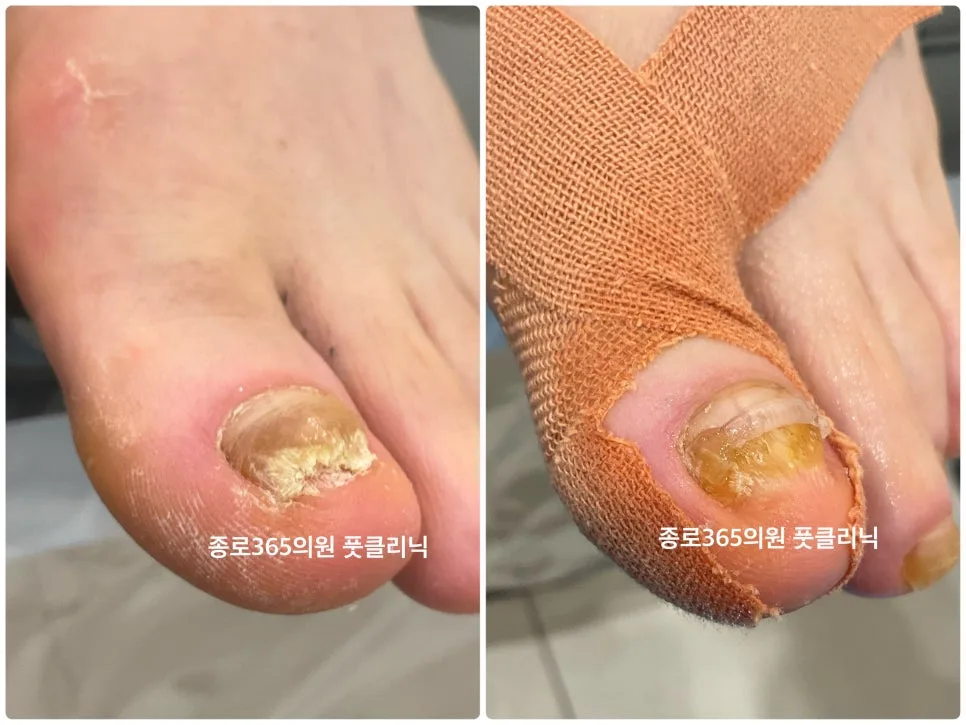 내성발톱과 발톱무좀 동시 교정 2026년 최신 치료법 2
